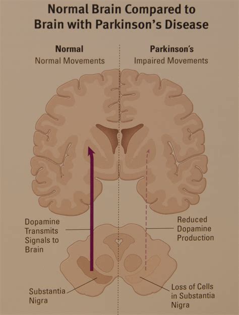 parkinson's in the brain
